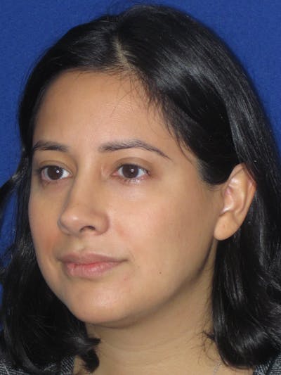 Rhinoplasty Before & After Gallery - Patient 247787 - Image 12