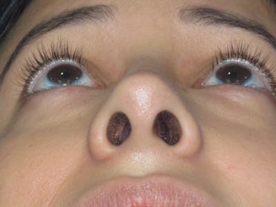 Rhinoplasty Before & After Gallery - Patient 247787 - Image 14