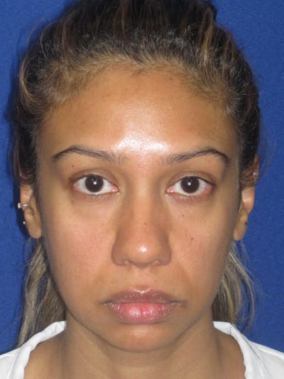 Rhinoplasty Before & After Gallery - Patient 327062 - Image 1