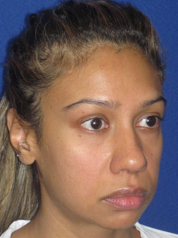 Rhinoplasty Before & After Gallery - Patient 327062 - Image 3
