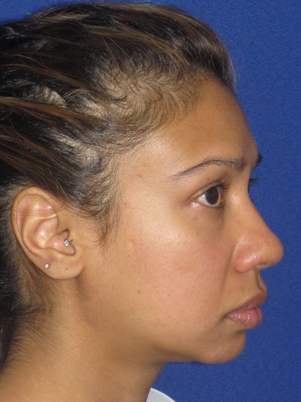 Rhinoplasty Before & After Gallery - Patient 327062 - Image 5