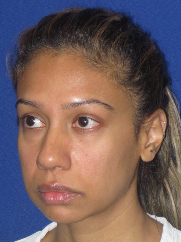Rhinoplasty Before & After Gallery - Patient 327062 - Image 7