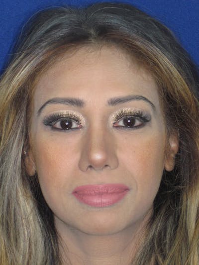 Rhinoplasty Before & After Gallery - Patient 327062 - Image 2