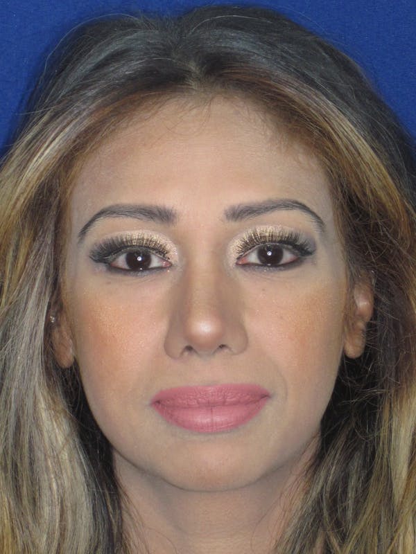 Rhinoplasty Before & After Gallery - Patient 327062 - Image 2