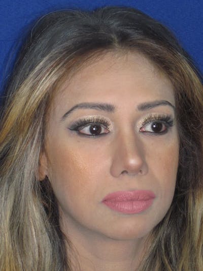 Rhinoplasty Before & After Gallery - Patient 327062 - Image 4