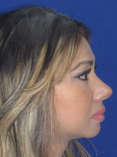 Rhinoplasty Before & After Gallery - Patient 327062 - Image 6