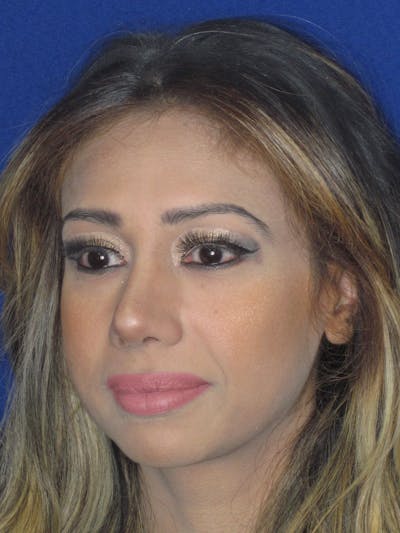 Rhinoplasty Before & After Gallery - Patient 327062 - Image 8