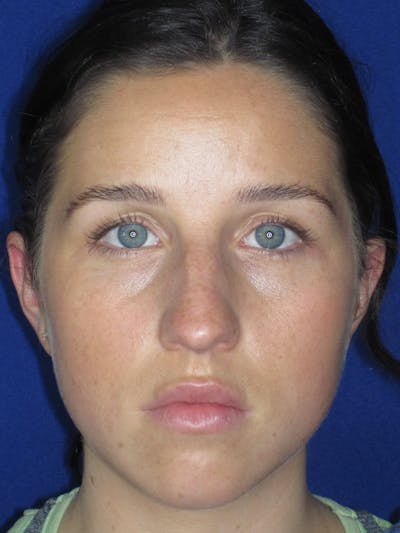 Rhinoplasty Before & After Gallery - Patient 156565 - Image 1