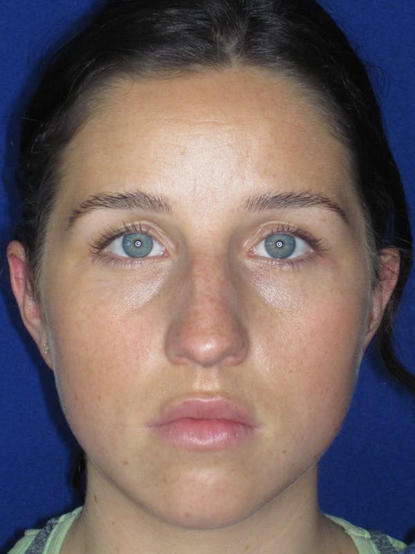 Rhinoplasty Before & After Gallery - Patient 156565 - Image 1