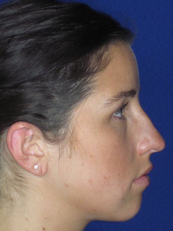 Rhinoplasty Before & After Gallery - Patient 156565 - Image 5