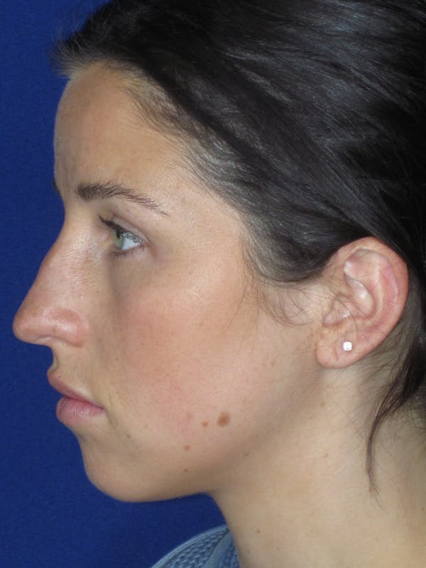 Rhinoplasty Before & After Gallery - Patient 156565 - Image 9