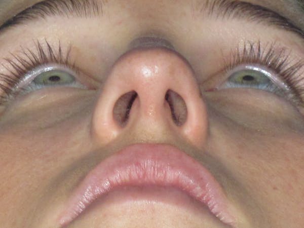 Rhinoplasty Before & After Gallery - Patient 156565 - Image 11