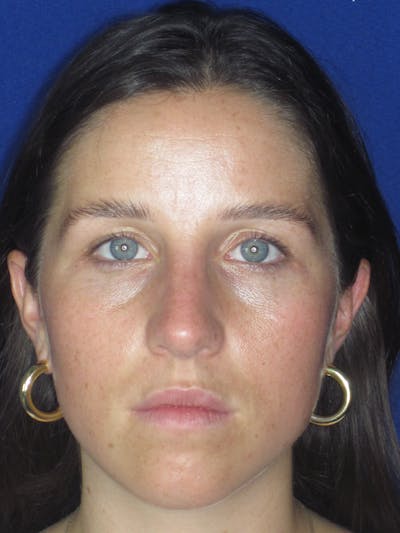 Rhinoplasty Before & After Gallery - Patient 156565 - Image 2