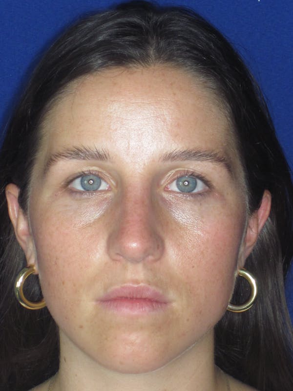 Rhinoplasty Before & After Gallery - Patient 156565 - Image 2