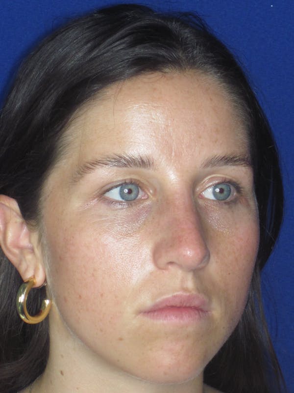 Rhinoplasty Before & After Gallery - Patient 156565 - Image 3