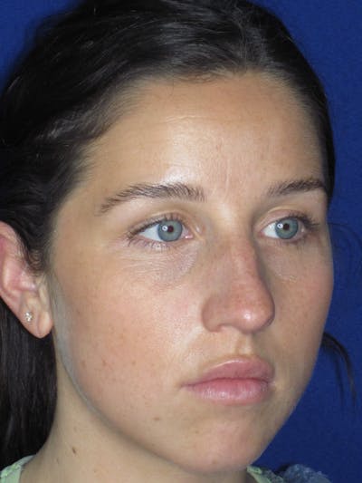 Rhinoplasty Before & After Gallery - Patient 156565 - Image 4