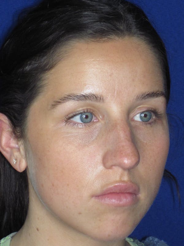 Rhinoplasty Before & After Gallery - Patient 156565 - Image 4