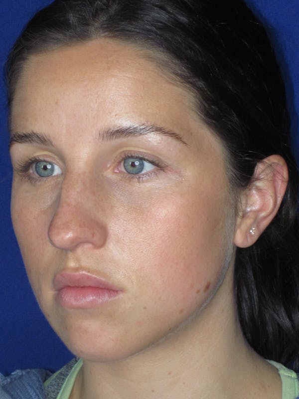 Rhinoplasty Before & After Gallery - Patient 156565 - Image 7