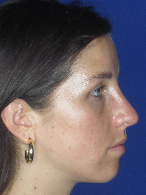 Rhinoplasty Before & After Gallery - Patient 156565 - Image 6