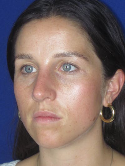 Rhinoplasty Before & After Gallery - Patient 156565 - Image 8