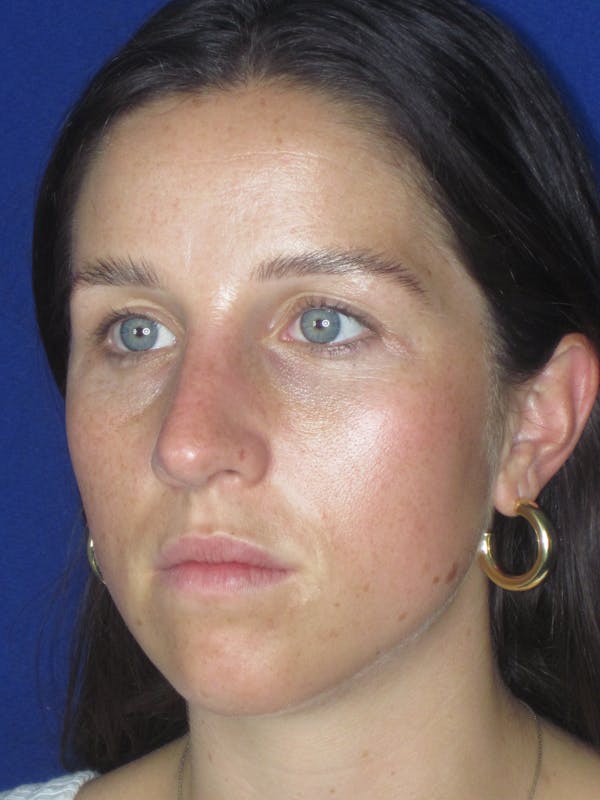 Rhinoplasty Before & After Gallery - Patient 156565 - Image 8