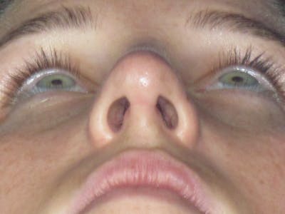 Rhinoplasty Before & After Gallery - Patient 156565 - Image 12