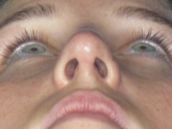 Rhinoplasty Before & After Gallery - Patient 156565 - Image 12