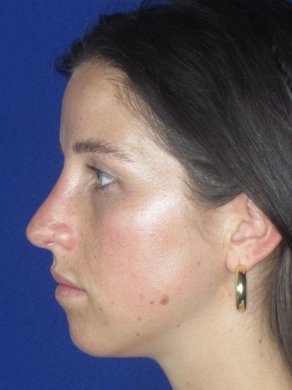 Rhinoplasty Before & After Gallery - Patient 156565 - Image 10