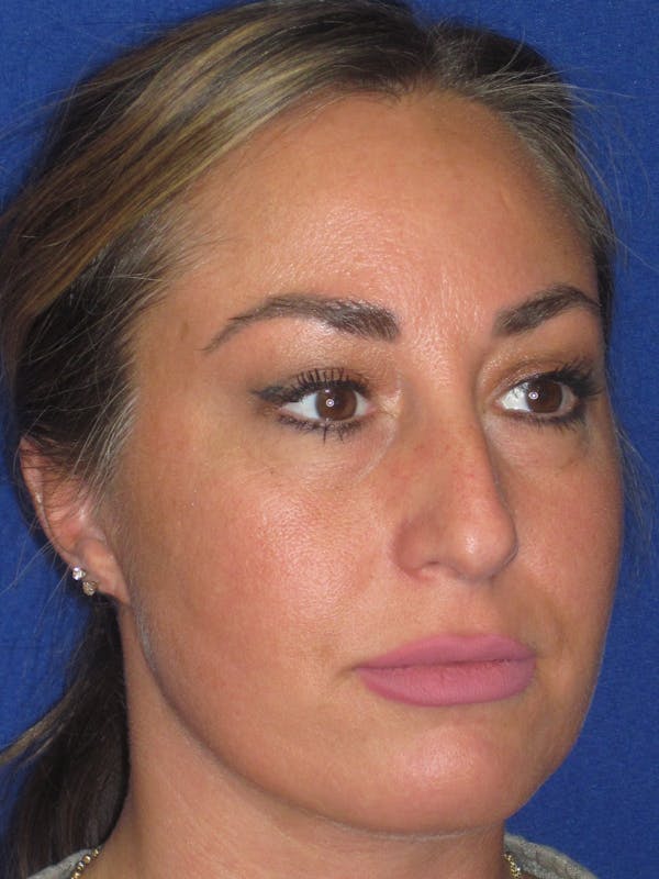 Rhinoplasty Before & After Gallery - Patient 379740 - Image 5