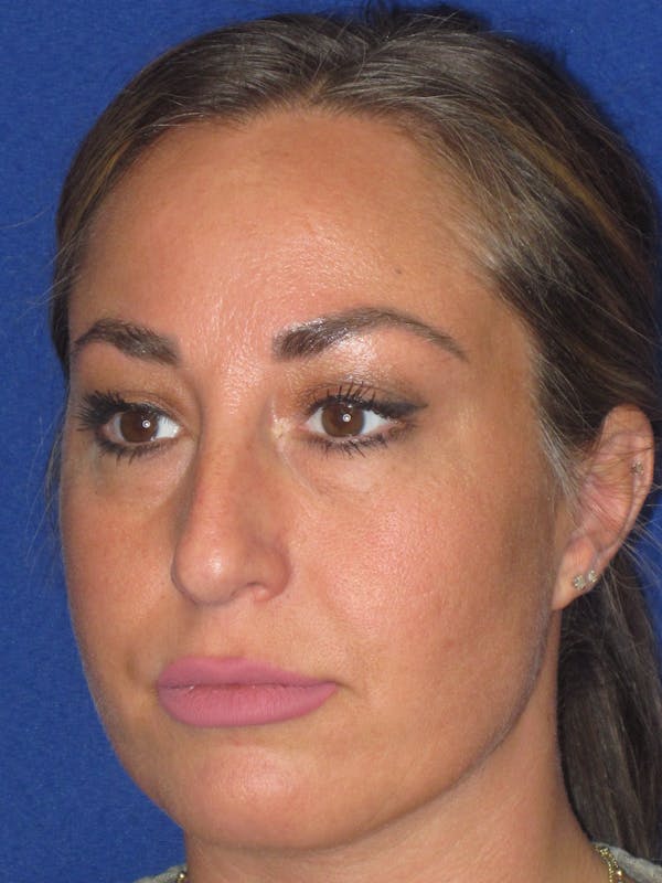 Rhinoplasty Before & After Gallery - Patient 379740 - Image 9