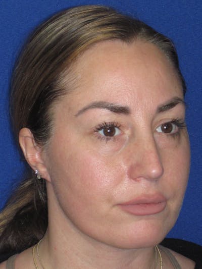 Rhinoplasty Before & After Gallery - Patient 379740 - Image 6