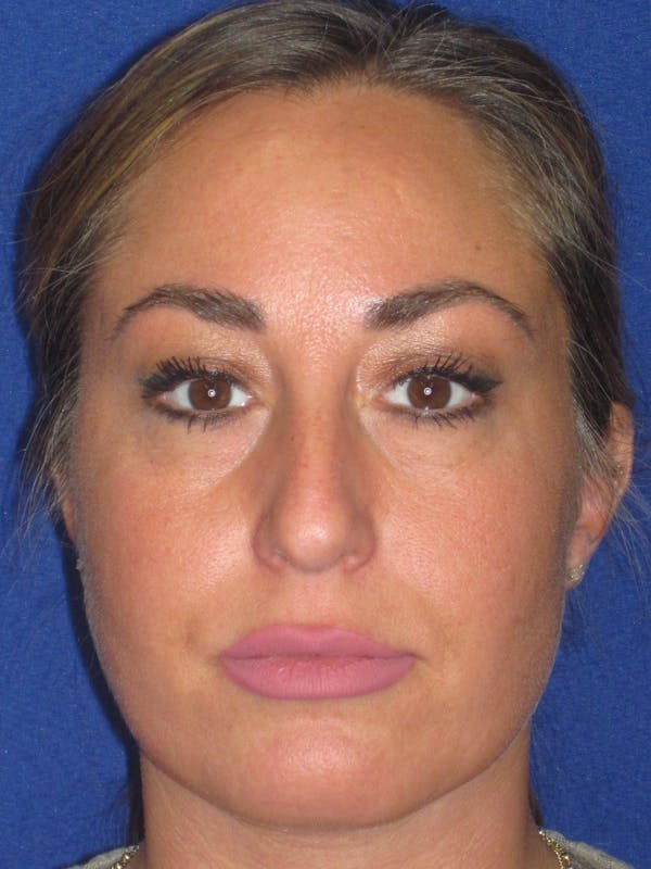 Rhinoplasty Before & After Gallery - Patient 379740 - Image 3