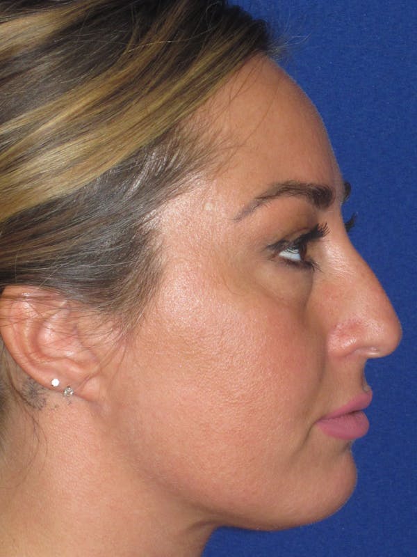 Rhinoplasty Before & After Gallery - Patient 379740 - Image 7