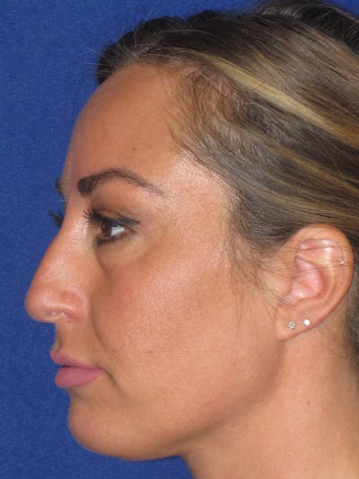 Rhinoplasty Before & After Gallery - Patient 379740 - Image 1