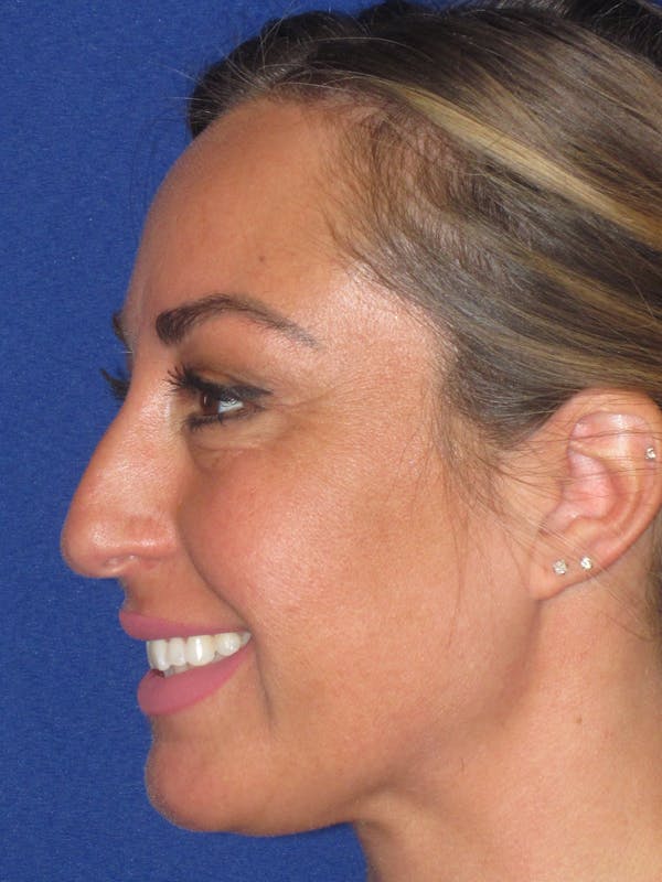 Rhinoplasty Before & After Gallery - Patient 379740 - Image 11