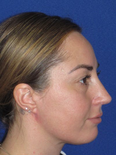 Rhinoplasty Before & After Gallery - Patient 379740 - Image 8