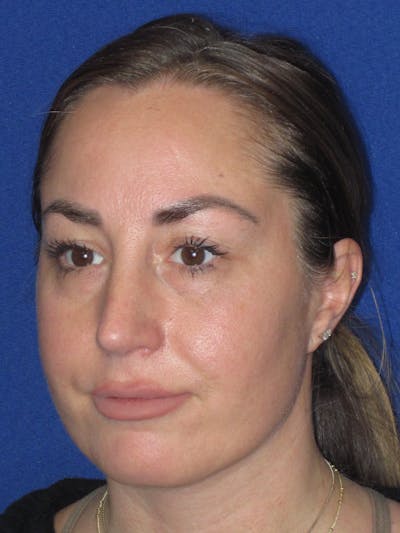 Rhinoplasty Before & After Gallery - Patient 379740 - Image 10