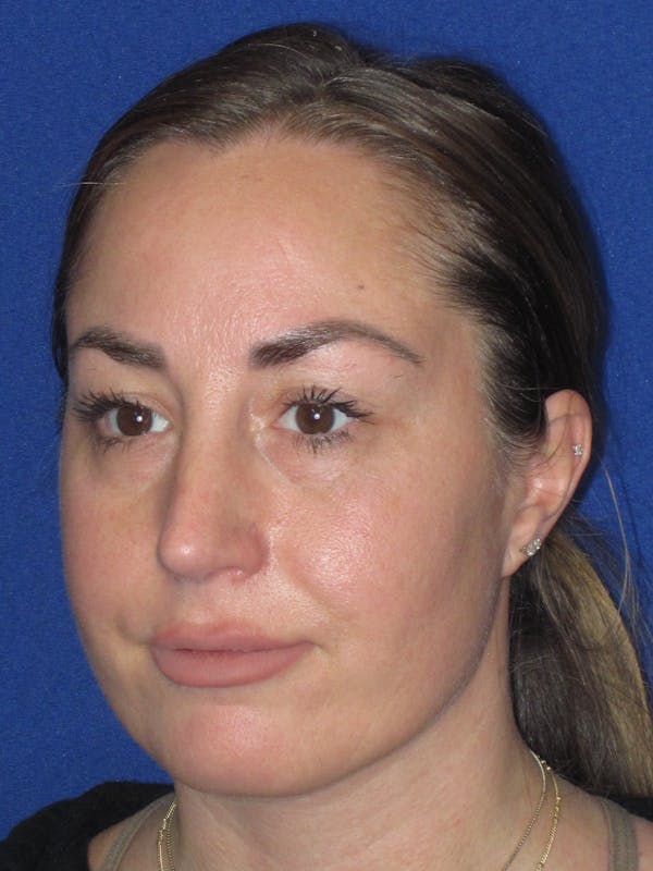 Rhinoplasty Before & After Gallery - Patient 379740 - Image 10