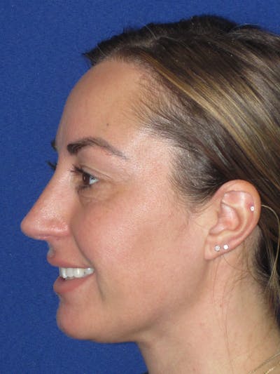 Rhinoplasty Before & After Gallery - Patient 379740 - Image 12