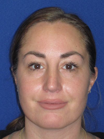 Rhinoplasty Before & After Gallery - Patient 379740 - Image 4