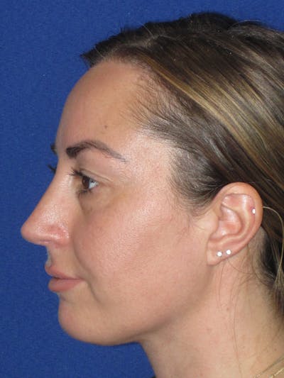 Rhinoplasty Before & After Gallery - Patient 379740 - Image 2
