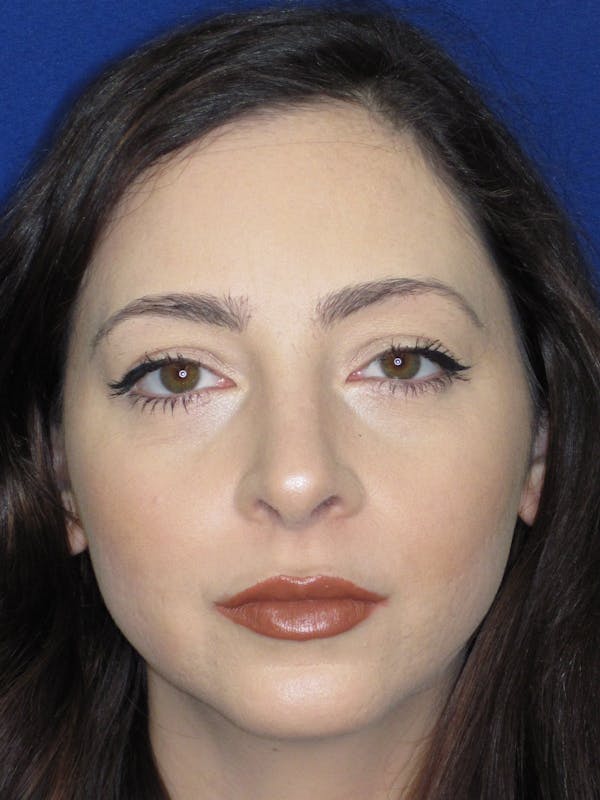 Rhinoplasty Before & After Gallery - Patient 320588 - Image 4