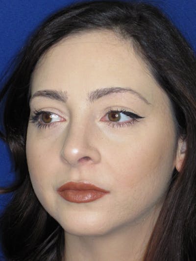 Rhinoplasty Before & After Gallery - Patient 320588 - Image 6