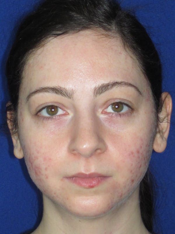 Rhinoplasty Before & After Gallery - Patient 320588 - Image 3