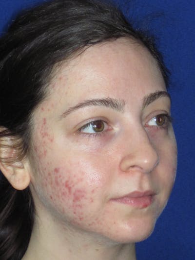 Rhinoplasty Before & After Gallery - Patient 320588 - Image 1