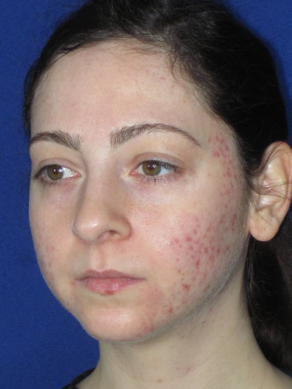 Rhinoplasty Before & After Gallery - Patient 320588 - Image 5