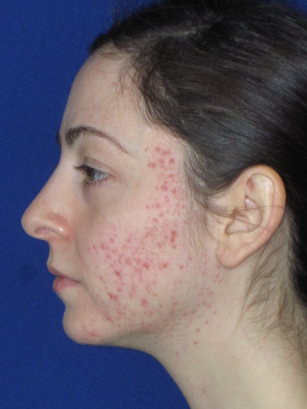Rhinoplasty Before & After Gallery - Patient 320588 - Image 7