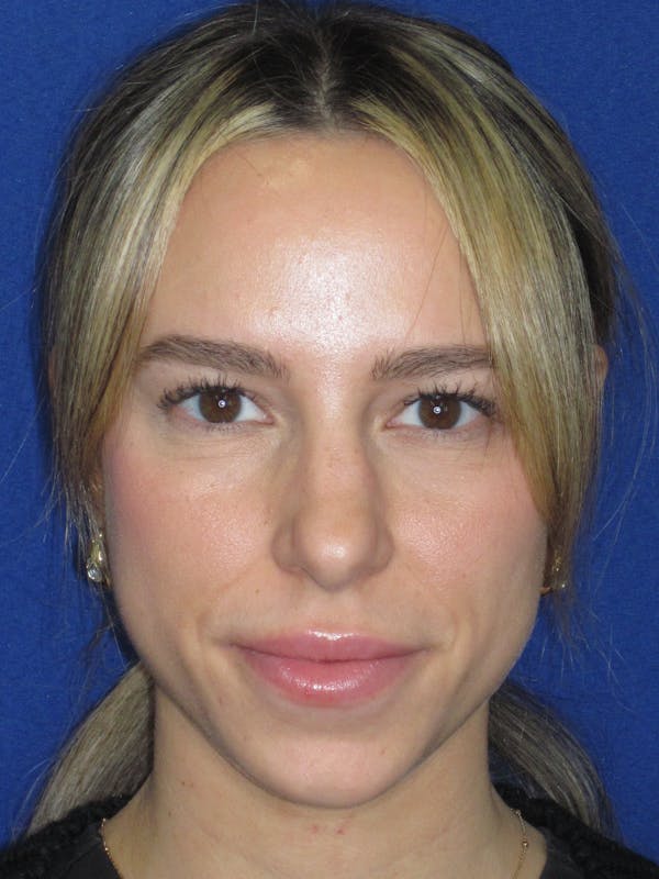 Rhinoplasty Before & After Gallery - Patient 257950 - Image 3