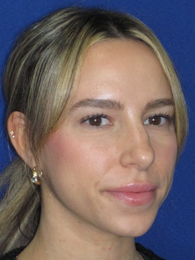 Rhinoplasty Before & After Gallery - Patient 257950 - Image 1
