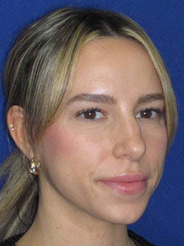 Rhinoplasty Before & After Gallery - Patient 257950 - Image 1
